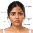 Hot and dry weather skin concerns including tanning, sweating, dehydration, acne and pimples on Indian skin